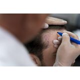 Saç Ekimi Sonrası Bu Kurallar Hayati Önem Taşıyor