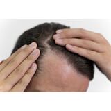 Tiroid Hastalığında Kaybedilen Saçlar Safir Fue Tekniğiyle Geri Kazandırılıyor