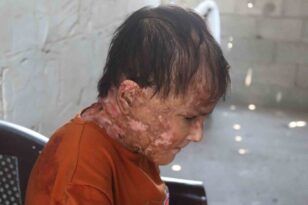 Gazze’de nadir cilt hastalığıyla mücadele eden genç kız: “İyileşip elbise giymenin hayalini kuruyorum”